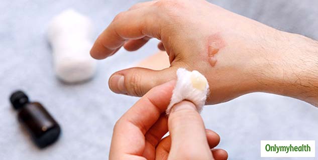 Tips For Burn Hand