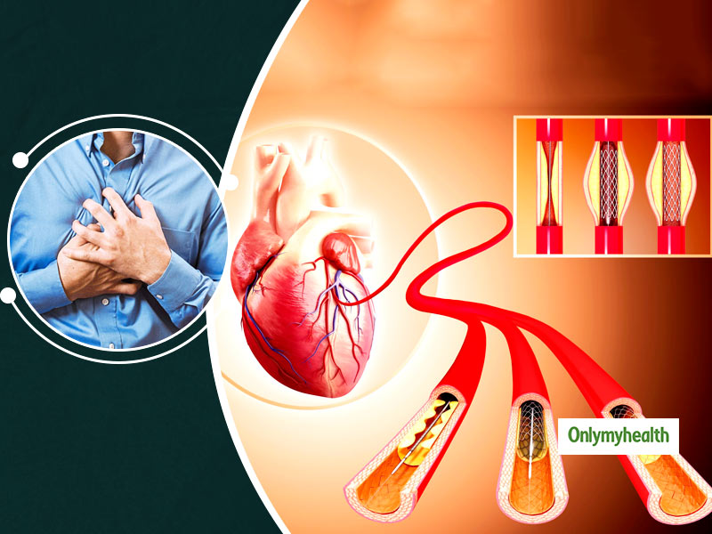 Stent And Bypass Surgery: Is It Beneficial For Heart Patients? Play This Quiz And Know More