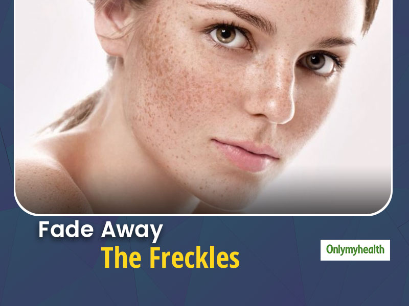 Lighten Freckles Naturally With These Easy And Effective Remedies Onlymyhealth 1294