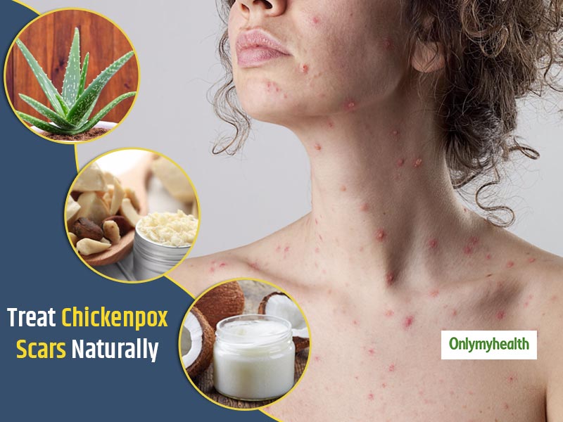 It Is Possible To Treat Chickenpox Scars, Try These Home Remedies
