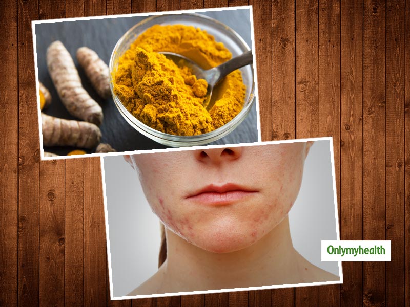 Turmeric for acne treatment