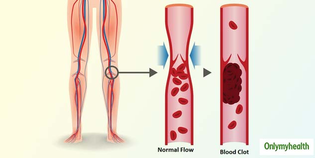 insidewhatisbloodcloting