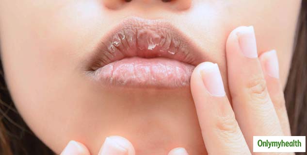Dry Lips