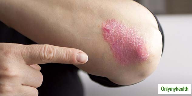 psoriasis treatment
