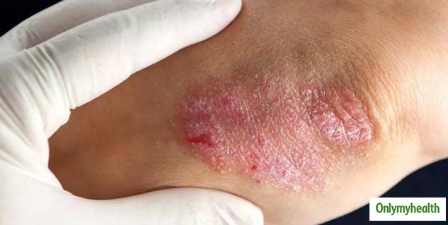 psoriasis