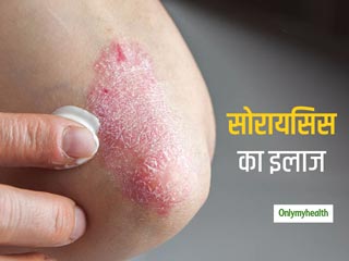 क्या है सोरायसिस का मेडिकल और आयुर्वेदिक इलाज? विस्तार से जानें इसके बारे में