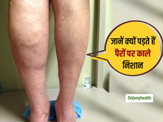पैरों में पड़ने वाले काले निशान को भूल कर भी न करें नजरअंदाज, जानें क्या है इसके कारण और बचाव