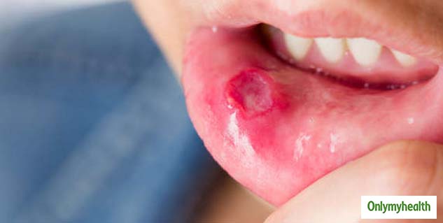lip cancer