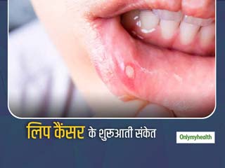 लंबे समय तक होंठ पर छाले और सूजन हो सकते हैं लिप कैंसर का संकेत, जानें इसके लक्षण और बचाव