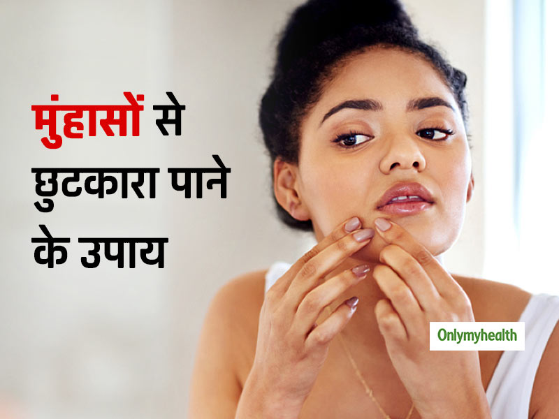 गर्मियों में चेहरे पर निकलने वाले मुंहासों को दूर करने के 5 आसान नुस्‍खे, जानिए क्‍यों होते हैं ये