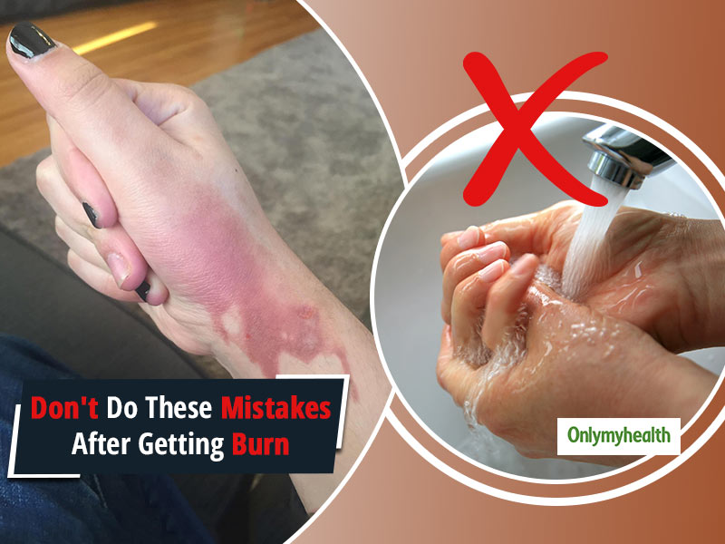 Burnt Your Hand? Avoid These Common First Aid Mistakes To Prevent Serious Complications