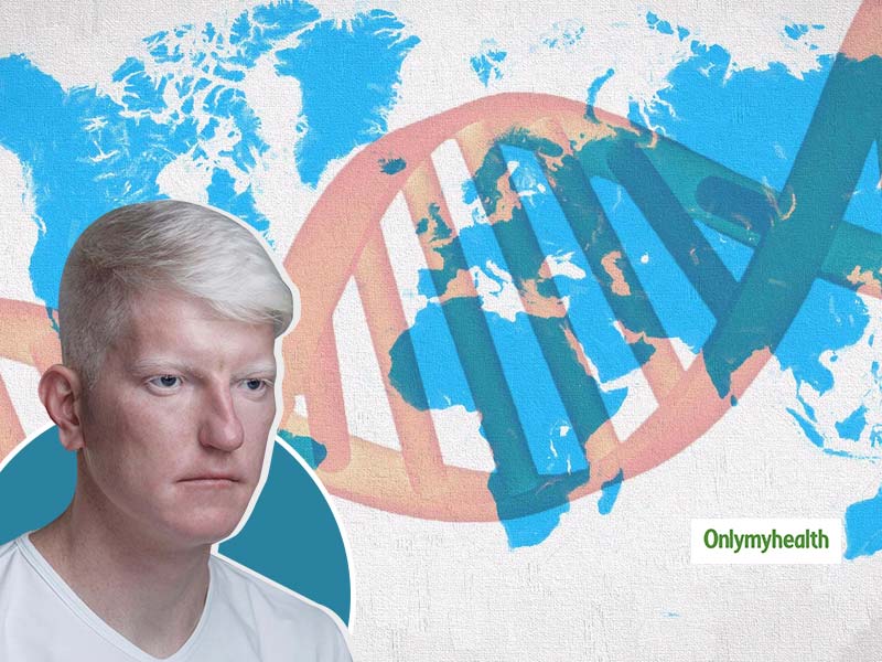 DNA Tests Determine The Precise Type Of Albinism: National Organization For Albinism And Hypopigmentation