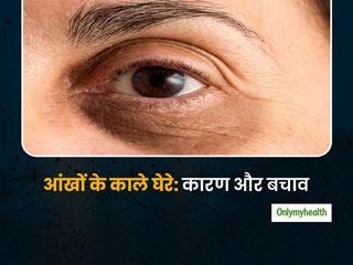 आंखों के नीचे काले घेरे (Dark Circles) होने की वजह और इसके उपचार के बारे में बता रही हैं डॉक्‍टर हेमा पन्‍त