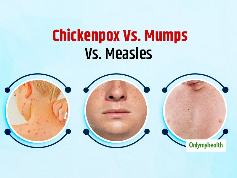 Remedies mumps natural for Natural cure