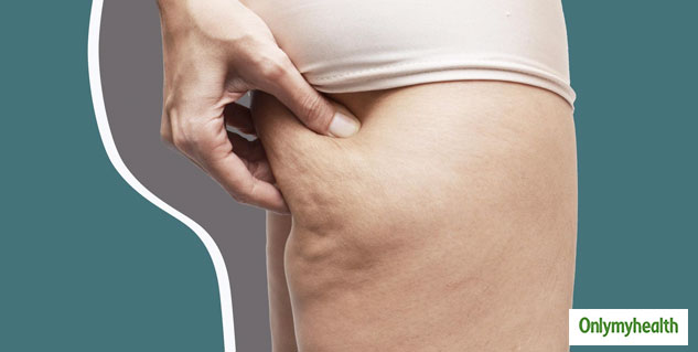 cellulite