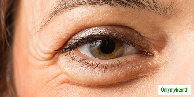 eye bags