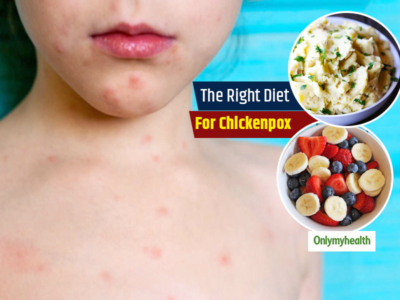 5 Types Of Foods That We Should Totally Eat To Recover Well From Chickenpox