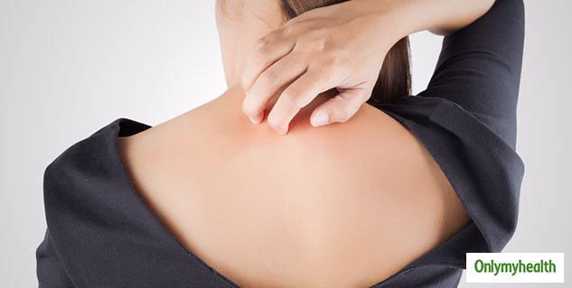 howt-to-cure-prickly-heat