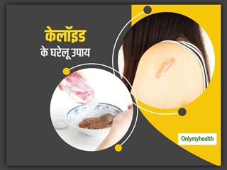 Home Remedies For Keloids : त्‍वचा पर असामान्‍य आकार के निशान (केलोइड्स) से छुटकारा पाना है तो अपनाएं ये उपाय