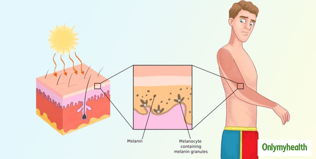 symptoms of sunburned eyeballs