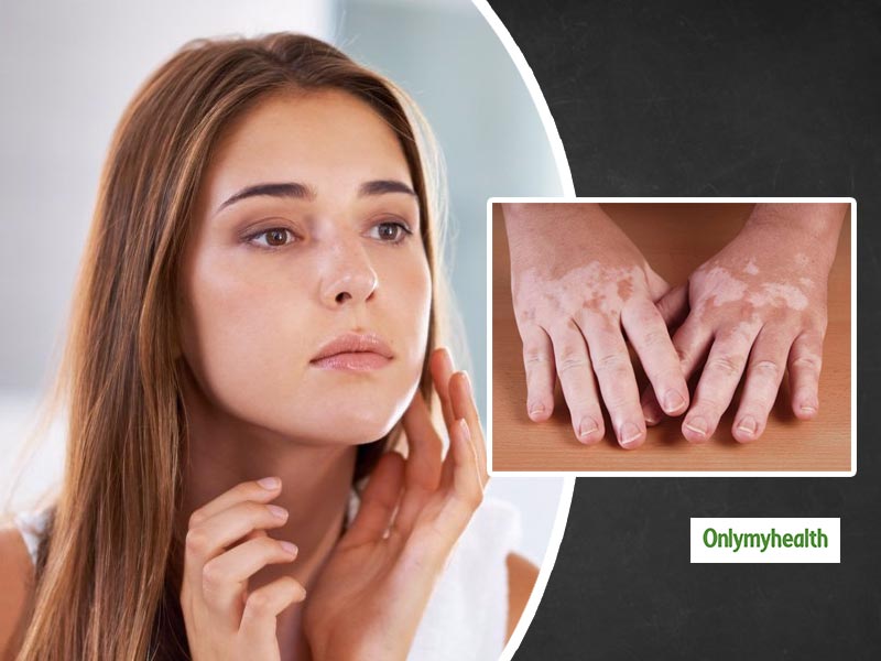 Learn About Different Types Of Skin Pigment Disorders And Tips To