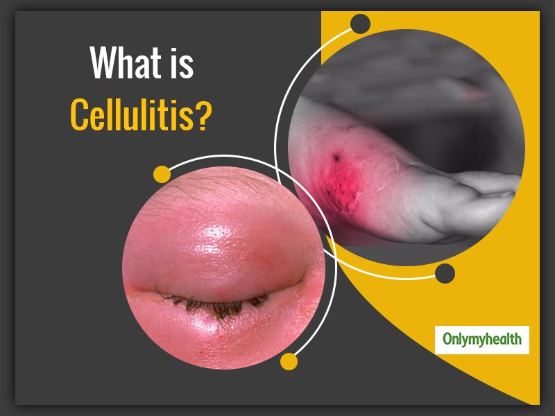 Cellulitis Symptoms Causes Pictures And Treatment