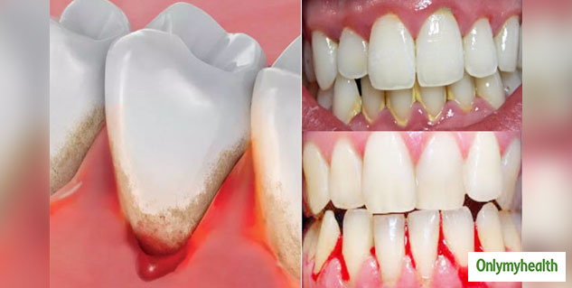 Gum Bleeding