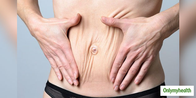 weight-change-and-skin-sagging