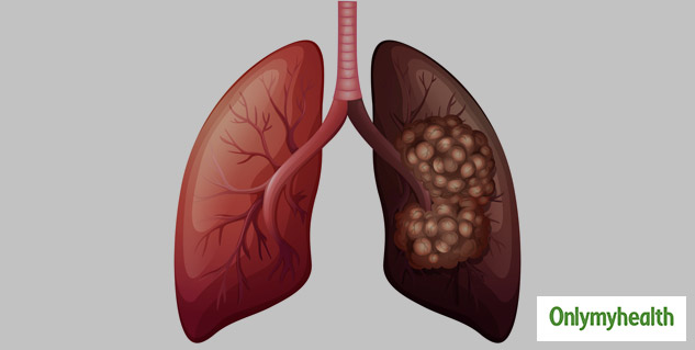 researchers-warn-of-irreversible-lung-problem-later-in-life-after-covid