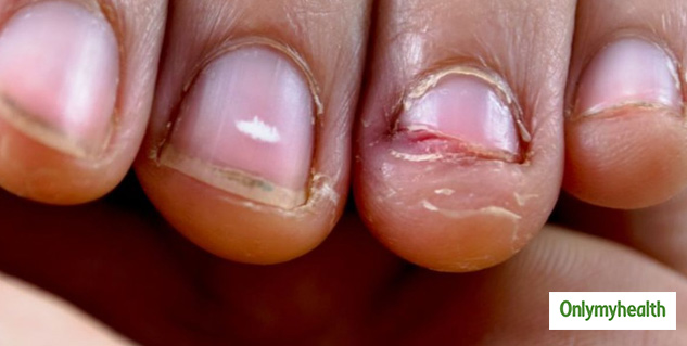 5 ways to treat Brittle nails – Derma Essentia