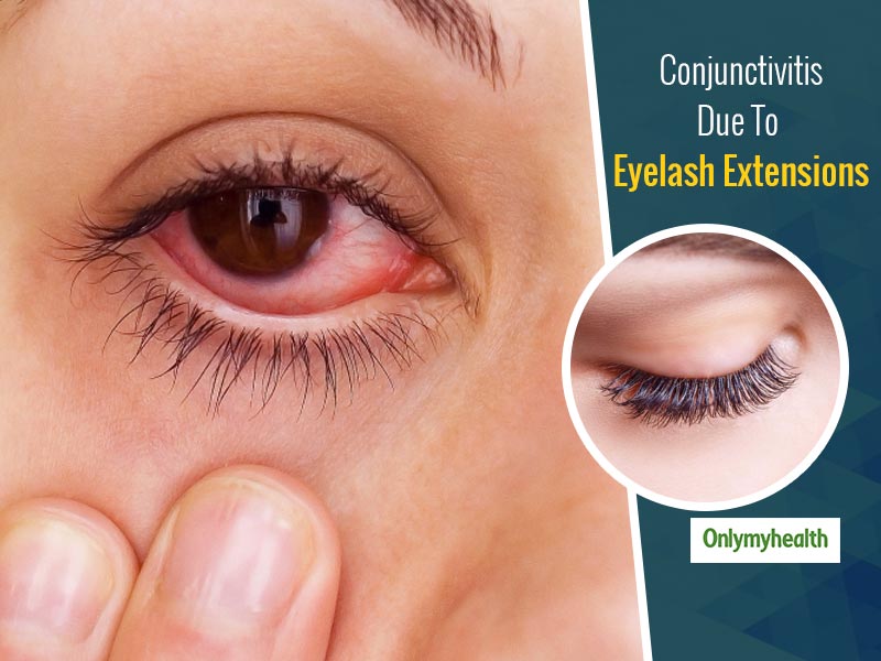 Eyelash Extensions Can Cause Conjunctivitis Here Is What You Need To Know