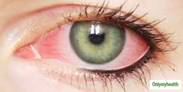 conjunctivitis