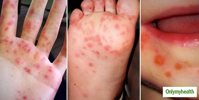 hand-foot-and-mouth-disease-symptoms-causes-and-care-tips-onlymyhealth