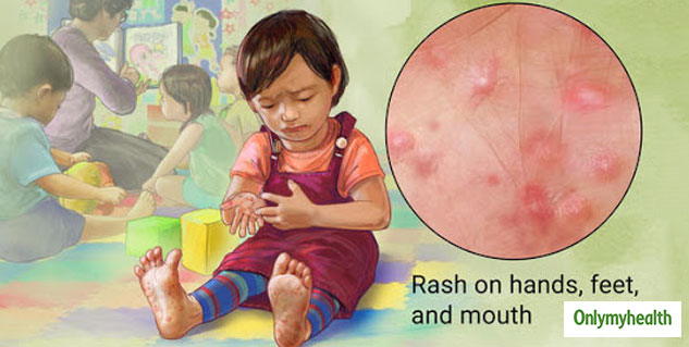 Hand, Foot And Mouth Disease: Symptoms, Causes And Care Tips | OnlyMyHealth