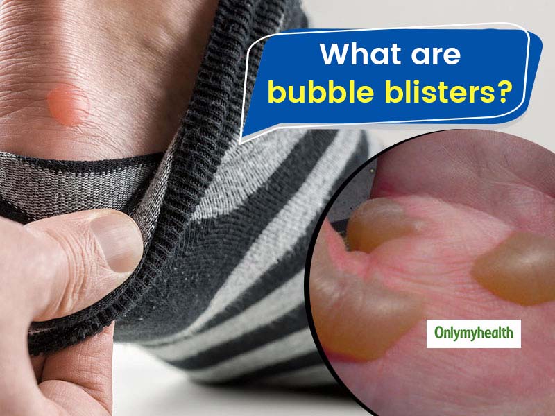 skin blisters causes