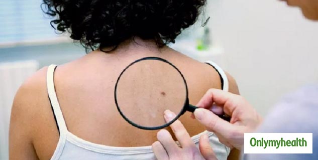Difference Between Mole or Melanoma