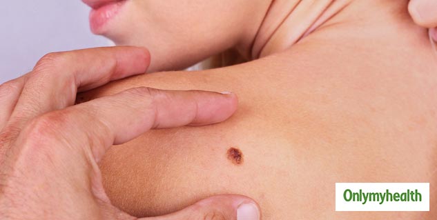 Melanoma Skin Cancer Signs