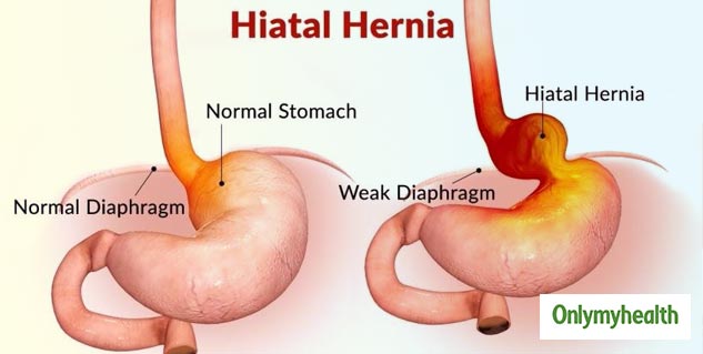 Hiatal Hernia In Men Know The Symptoms and Preventive Measures