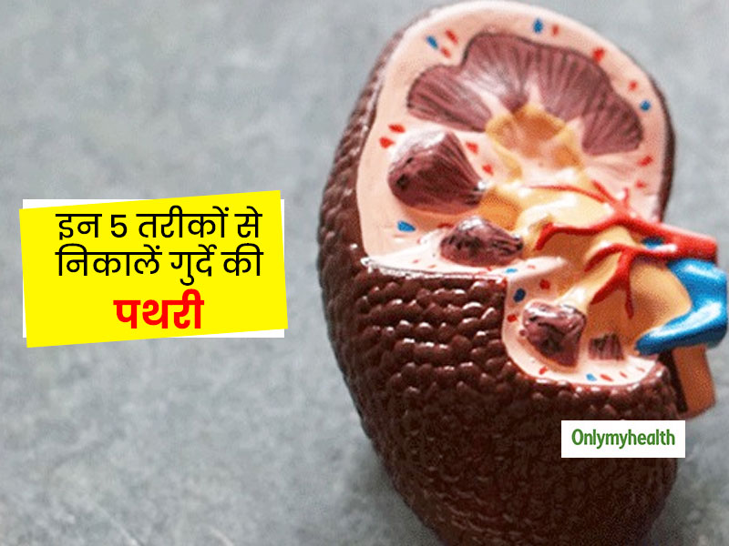 Kidney Stone Treatment with Ayurveda: गुर्दे की पथरी कर रही परेशान तो घर पर इन 5 तरीकों से निकालें बाहर