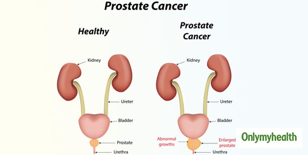 Prostate Cancer: Here’s How To Effectively Deal With It | OnlyMyHealth