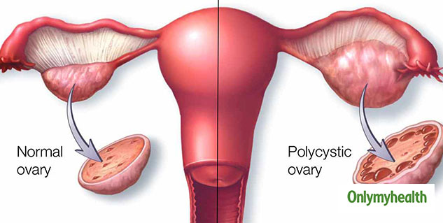 PCOS