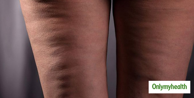 Cellulite 101: Causes, Myths, and Proven Solutions - MYSA