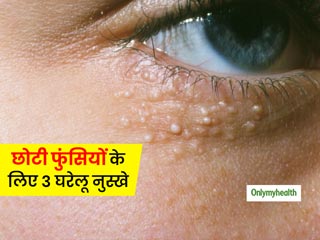 चेहरे पर निकलने वाली सफेद-पीली फुंसियों (मिलिया) से पाना है छुटकारा? ये हैं 3 आसान घरेलू उपाय