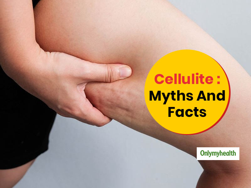 Myths And Facts About Cellulite You Should Know 