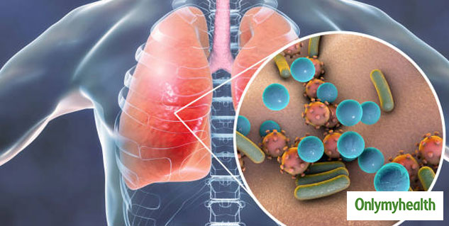 The 6 Types of Pneumonia, Their Symptoms and Causes | OnlyMyHealth
