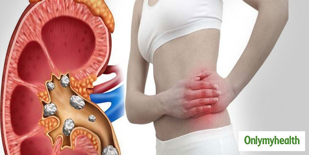 kidneystone