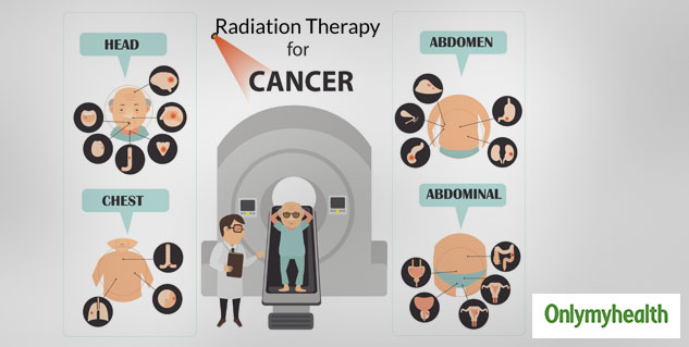 Side effects of Radiation Therapy