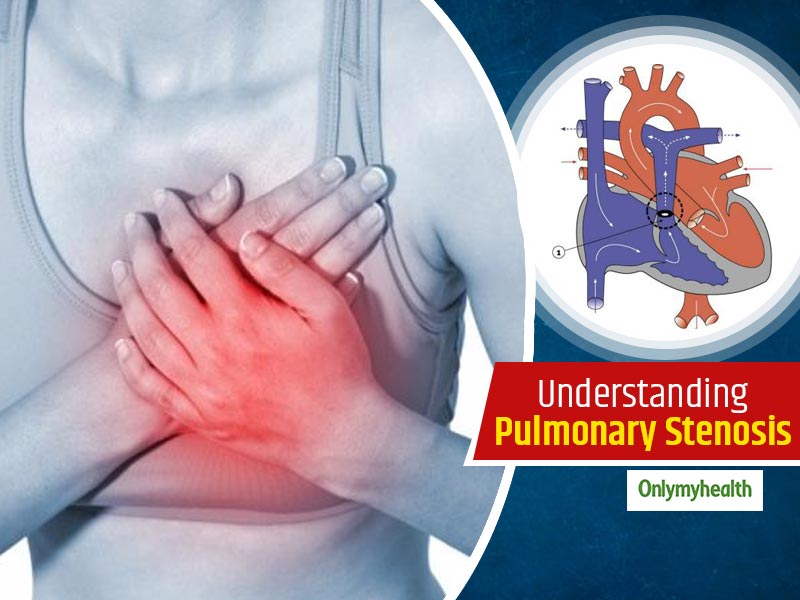 All You Need To Know About A Heart Condition Termed As Pulmonary Stenosis, Explains Dr Gaikwad