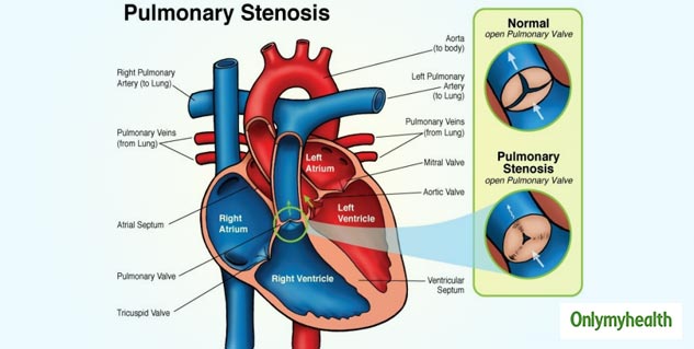 understasnding_all_about_Pulmonary_Stenosis
