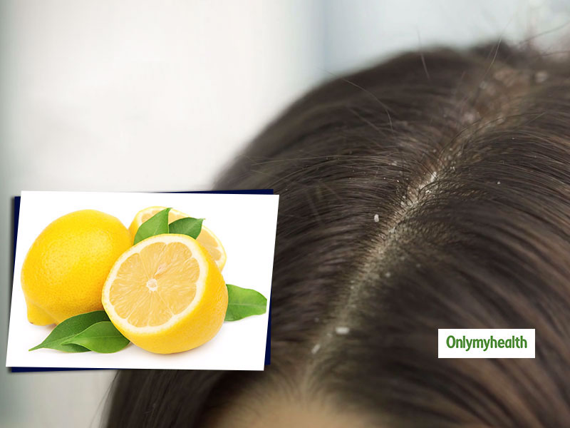 3 Easy Tips To Get Rid Of Dandruff With Lemon Juice
